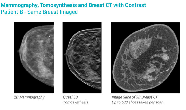 Izotropic Breast CT Imaging System targeting earlier cancer detection ...