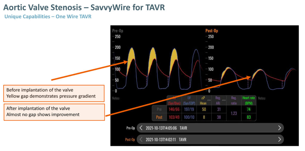 OpSens SavvyWire tackling cardiology with advanced optical devices