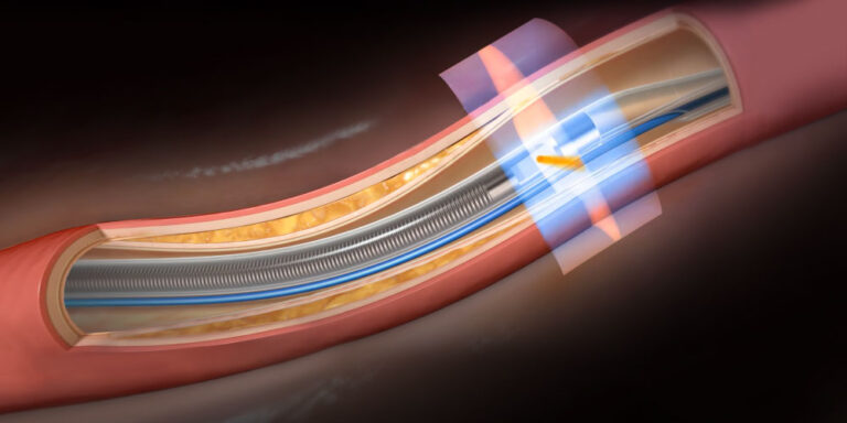 Conavi’s Novasight Shines New Light On Coronary Interventions - BioTuesdays